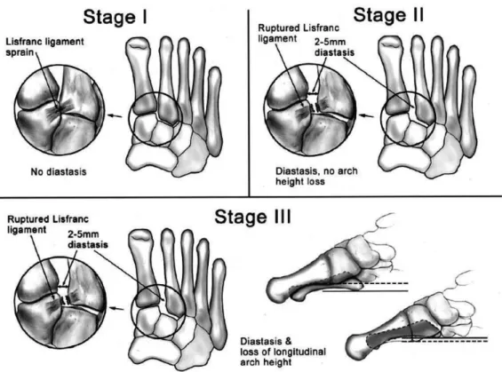 Figure 6.  The classification for subtle Lisfranc injuries by Nunley and Vertullo (2002)