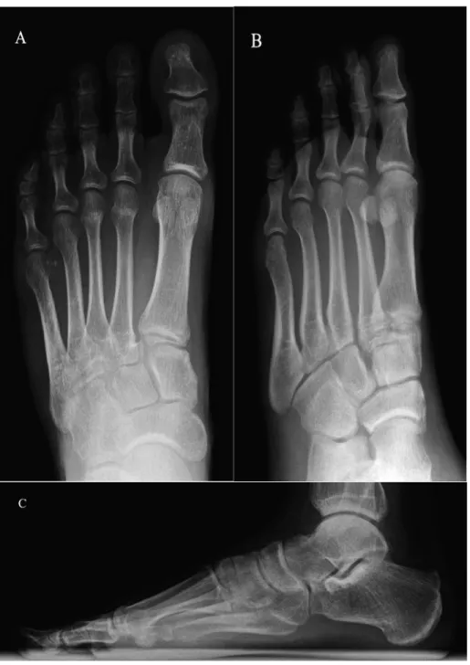 Figure 7.  Anteroposterior (A), oblique (30-45 degrees) (B), and lateral (C) radiograph projections of  the foot