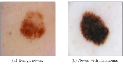 Figure 6: Examples of benign nevus and nevus diagnosed with melanoma from the nevus dataset (ISIC, 2019).