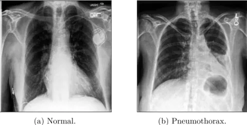 Figure 7: Examples of a normal chest X-ray and a chest X-ray with pneumothorax (Irvin et al., 2019).