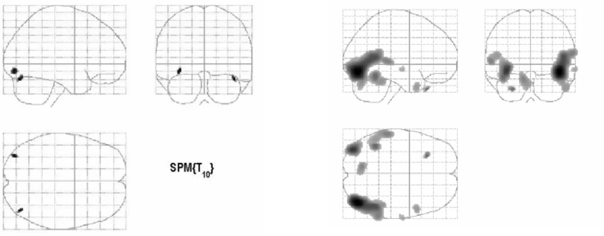 Figure 9. SPM versus SnPM results of voxel-based regression analysis in sagittal (upper  row; left), coronal (upper row; right) and axial (lower row) views