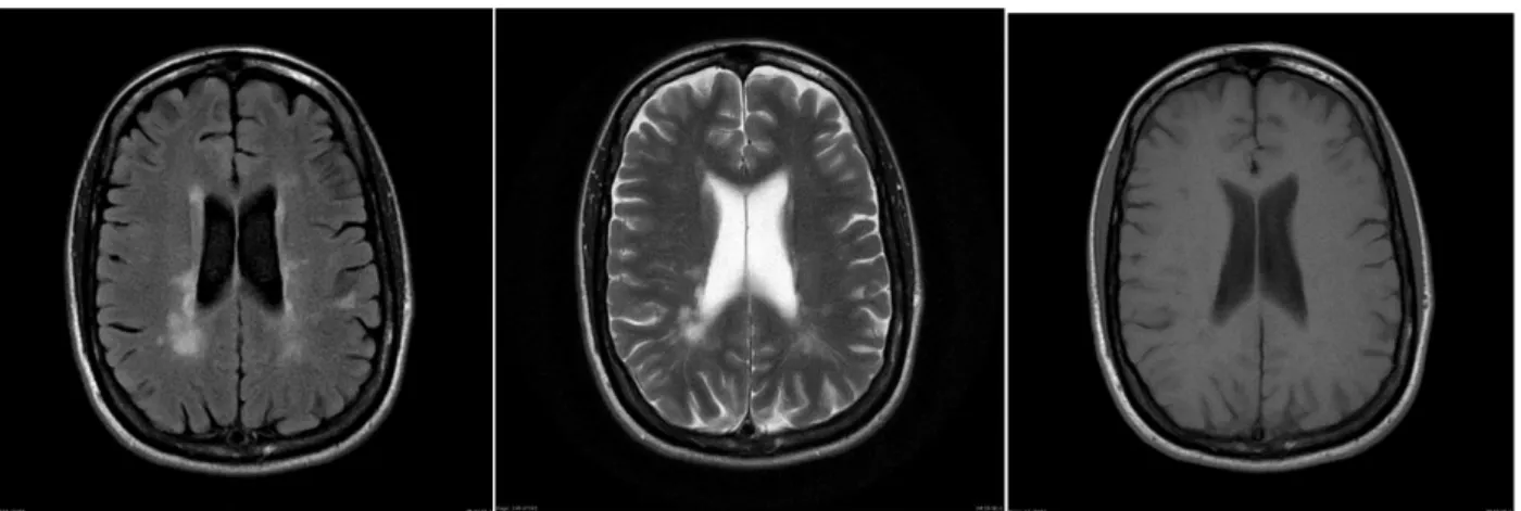 Kuva 2. 45-vuotiaan pitkään MS-tautia sairastaneen naisen MRI-kuvat. 