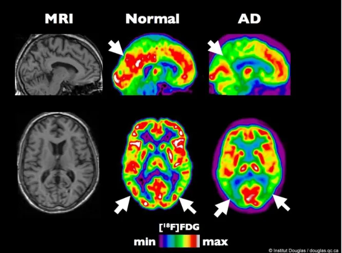 Kuva 4 FDG PET - Fluorodeoksiglukoosin kertymän väheneminen Alzheimerin taudissa. 