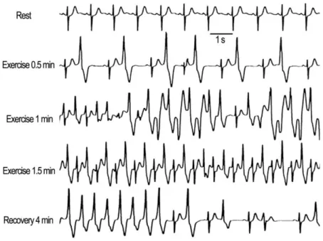 Figure  9. Exercise stress test of a CPVT patient with RyR2 mutation. The occurrence of ven- ven-tricular  arrhythmias  increases  during  exercise  but  decreases  during  recovery