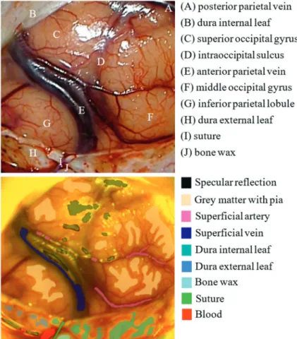 Figure 3. Anatomically annotated operation microscope RGB reference  image (top) and the corresponding HSI mask with labeled cortical healthy  tissue areas (bottom) of the patient ID 0001 after the opening of the dura