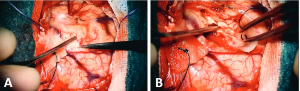 Figure 2. White light microscopy. Operating microscope view of the  coagulation of the cortical surface vessels (A) and the approach towards a  subcortical glioma amidst the parenchymal brain tissue (B)