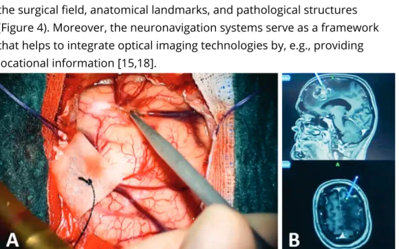 Figure 4. Intraoperative neuronavigation. A neuronavigation probe is  placed on the cortical surface (A) to localize the operative field in relation to  the preoperative magnetic resonance imaging scans (B)