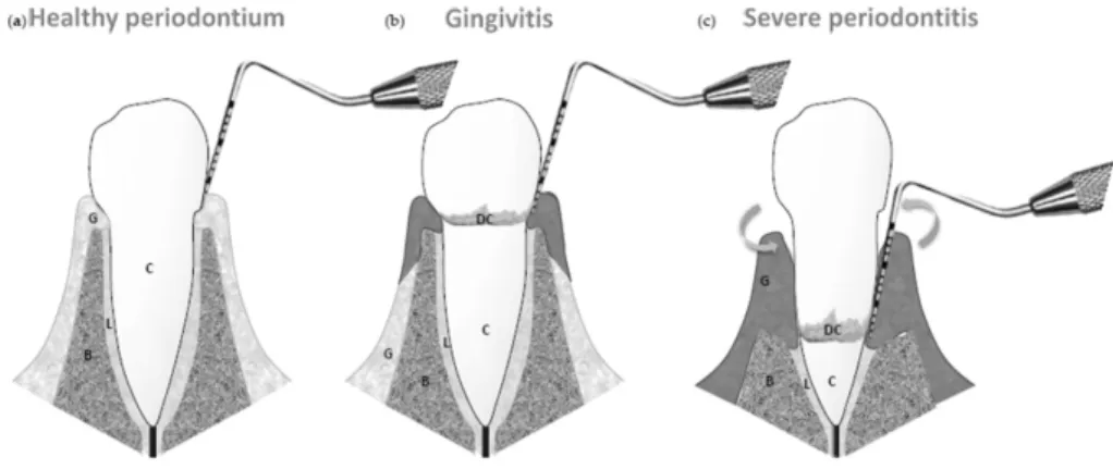 Figure 1  The structure of periodontium in (a) healthy periodontium, (b) gingivitis with plaque  and calculus (DC) and a reversible gingival inflammation, and (c) severe 