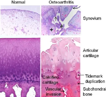 Figure 2.1: Comparing OA with a normal  tissue [18]. 