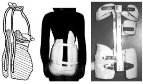 Fig. 3. Left, Milwaukee brace, vertical traction + side pressions.