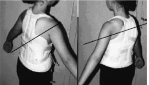 Fig. 4. An attempt to cure scoliosis with only soft bands has never got any success, as long as we are informed