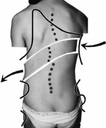 Fig. 9. Breathing without brace towards humps worsens scoliosis. Brace hinders it. The  Physio-therapist must teach the patient how to breathe out of his convex, and to breathe in toward his concave sides.