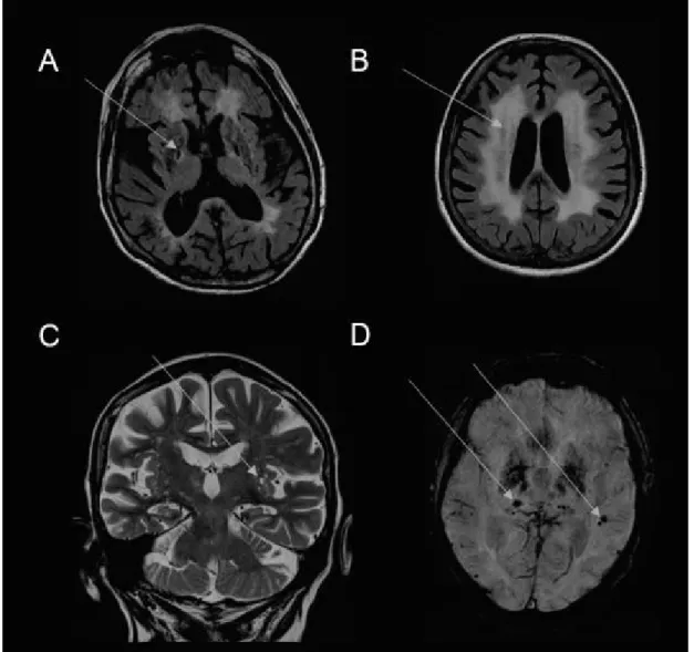 Obrázek  1.  Příklady  vybraných  běžných  strukturálních  změn  mozku  u  pacientů  s chronickým onemocněním ledvin při vyšetření zobrazovacími metodami 