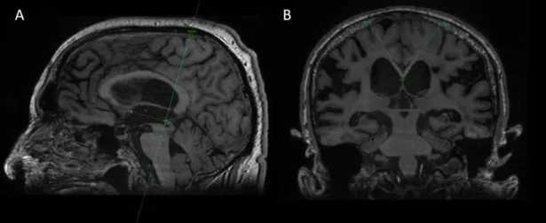 Obrázek 1.5: Úhel corpus callosum