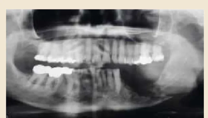 Fig. 8. Carierede tænder efter strålebehandling.