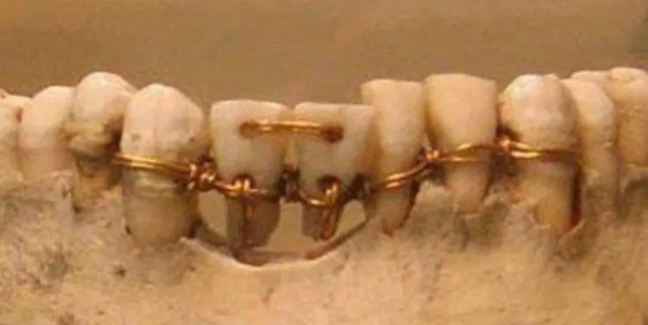 Fig. 1.1 . : Dental implants, connected in copper “bridges” with the rest teeth, in a discovered ancient  skull (1).