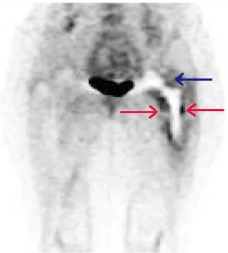 Figure 7.  Display of the inflammation in patient with prosthetic hip joint infection [67].