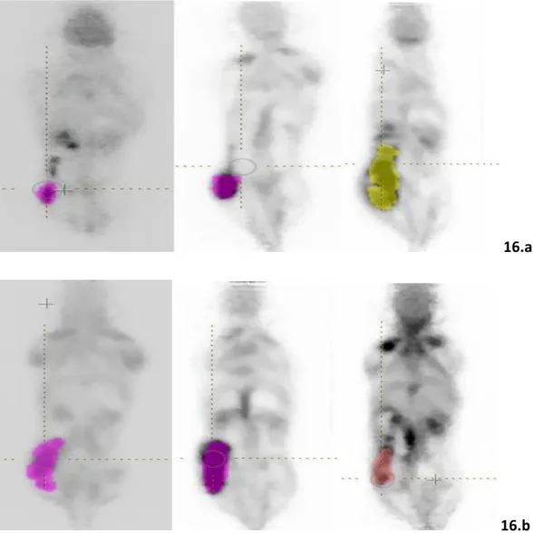 Figure 17.  The evolution of a tumor in a non-treated (16.a) and a treated (16.b) mouse, over the  course of 7, 10, and 14 days (from left (7 days) to right (14 days))