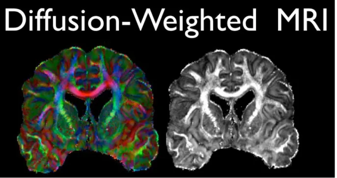 Figure 2-8 Diffusion Weighted Imaging 