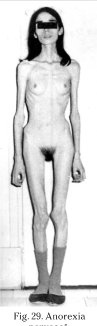 Fig. 29. Anorexia  nervoasă.