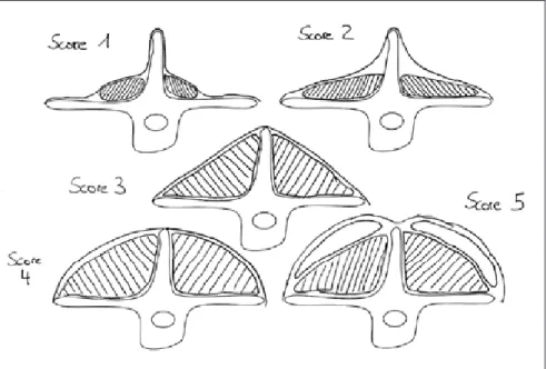 Abbildung 2: Sternaler Score 1-5 (Querschnitt durch brustkorb)Abbildung 1: Lumbarer Score 1-5 (rückenquerschnitt)
