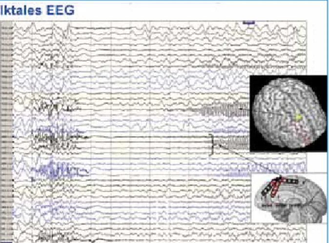 Abbildung  3:  Interiktales  EEG  mit  implantierten  subduralen  Elektroden