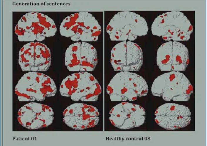 Figure 1: fMRI: Patient 01 shows a more bilateral activation of the language network in the task „generation of sentences“ in  contrast to the control 08