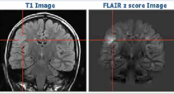 Figure 3: Quantitative hippocampal FLAIR analysis: The results of the example patient falling in the middle of the 95% confi- confi-dence region of healthy controls confirm the visual impression that there is no dual pathology in terms of an additional  hi