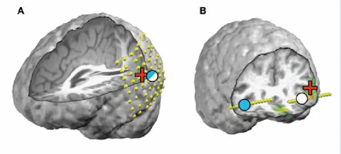 Figure 2: Accuracy of ESI of interictal spikes with intracranial EEG as the gold standard