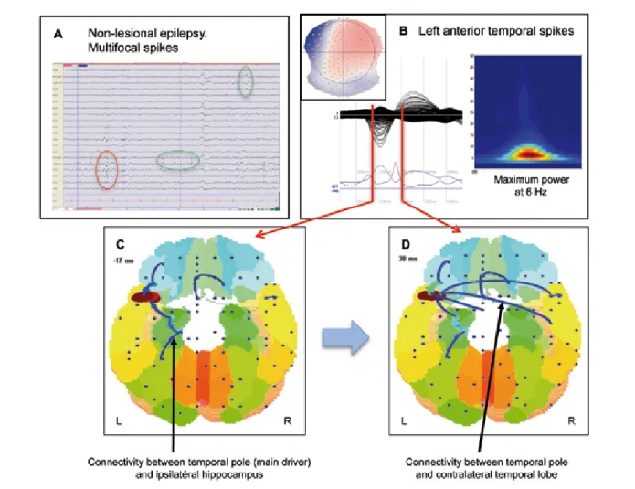 Figure 3: Directed connectivity in a patient with temporal lobe epilepsy using high-density EEG
