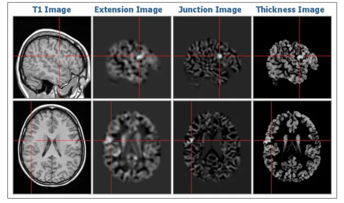 Figure 1: Morphometric MRI analysis: From the original T1 volume data set (left column), three new feature maps were calcu- calcu-lated, which in our example patient who suffered from so far cryptogenic focal epilepsy highlighted abnormal gyration/an  ab-n
