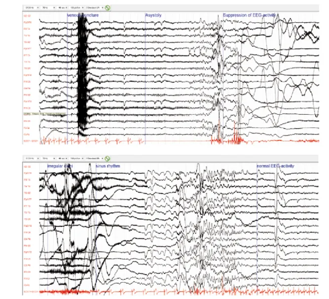 Figure 1: EEG during asystoly