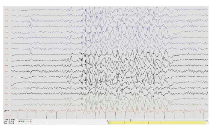Figure 2. Same patient. Light sleep on awaking showed frequent bursts of 4 Hz generalized spike-poly-spike wave-complexes,  of variable length, without clinical correlates