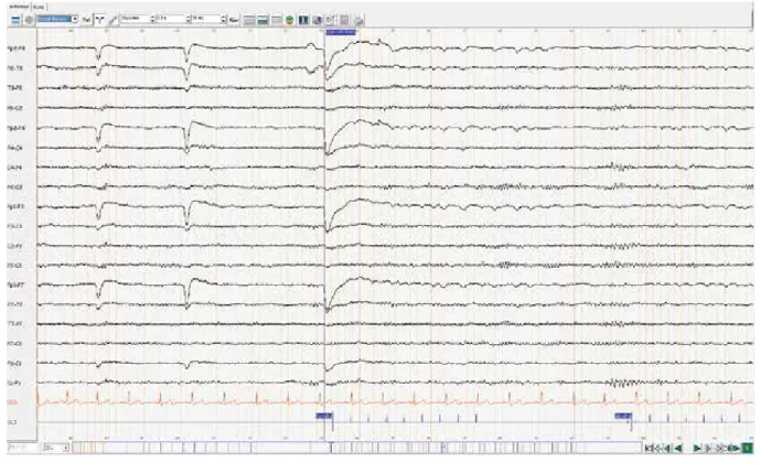 Figure 1. 19 y.o. patient with a first unprovoked generalized seizure during wakefulness