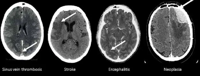 Figure 2: Causes of acute symptomatic seizure, Left: Contrast-enhanced CT-image depicting a thrombus within the superior  sagittal sinus