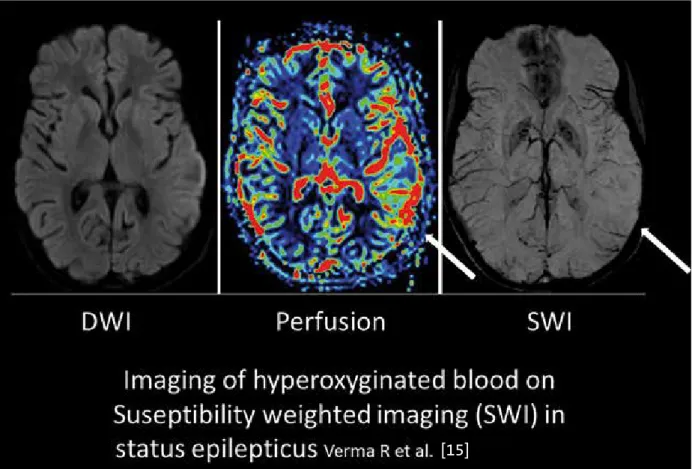 Figure 7: SWI showing on the right side disappearance of hypointensive signal in cortical veins in the region of ongoing hyper- hyper-perfusion (middle image) during non-convulsive status epilepticus