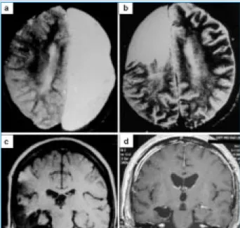 Figure 2: Magnetic resonance images depicting examples of various epilepsy surgeries. (a) Hemispherectomy in a patient with Rasmussen’s encephalitis