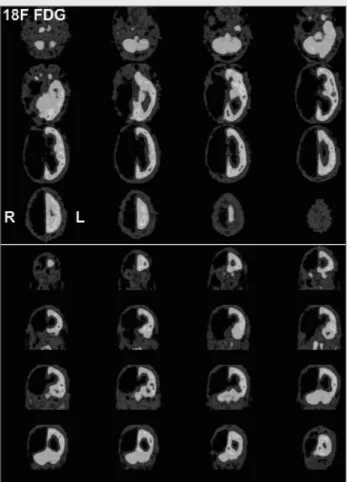 Figure 4. Ictal FDG PET study in a patient with a prolonged sta- sta-tus-like seizure discharge in the left temporo-occipital cortex.