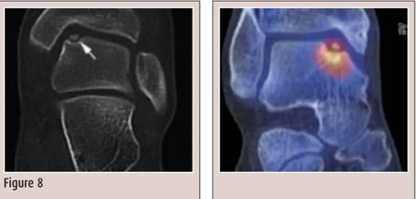 Figure 6  Articulation tibio-astragalienne incongruente, pouvant signer une lésion syndesmotique Figure 7  Exemple de stabilisation d’une lésion chronique de la syndesmose