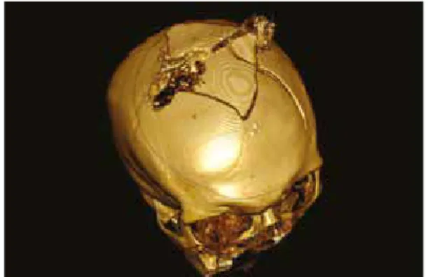 Figure 3: Post-mortem  CT scan of a  self-inflicted shot-gun  wound to the head  (3D reconstruction)